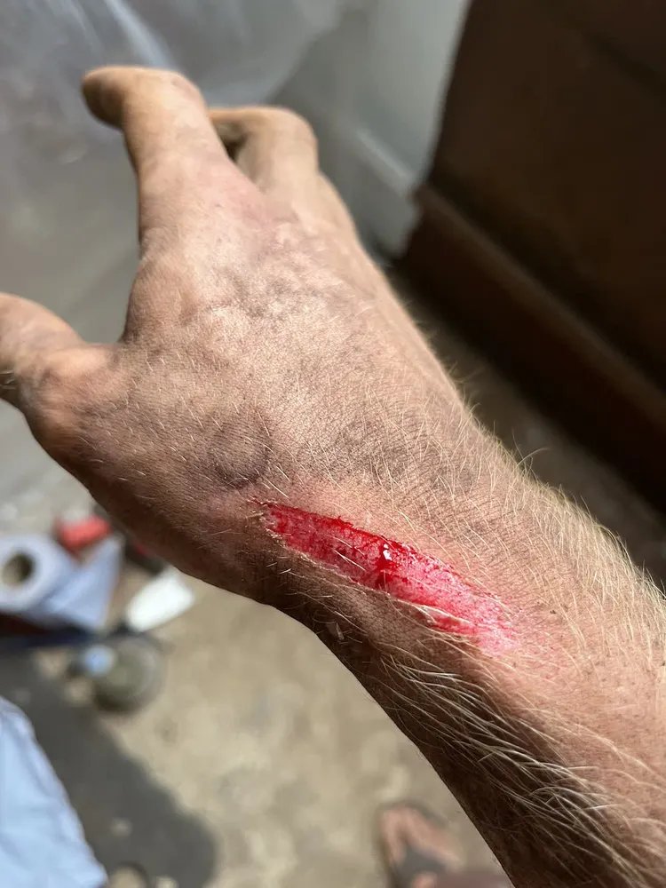 Angle grinder flesh wound
